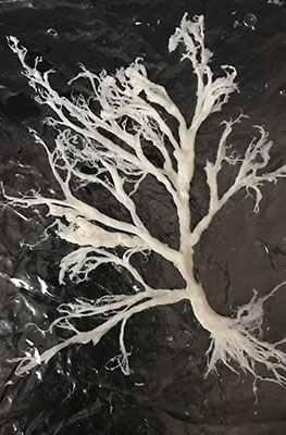 Cast of plastic bronchitis